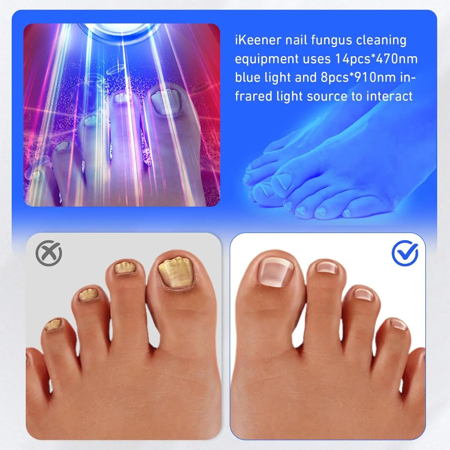 Wireless Nail Fungus Laser - Frezy Haven 